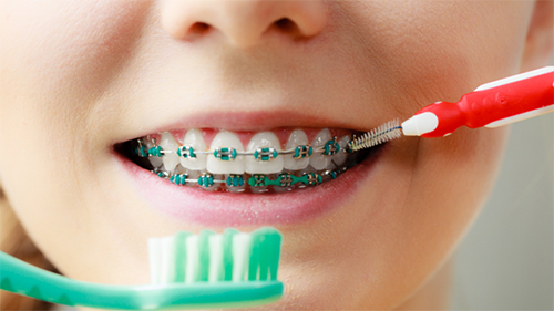 การดูแลฟัน-ระหว่างการจัดฟัน