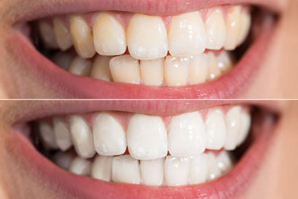 ฟอกฟันขาว ฟอกสีฟัน ฟอกฟันขาวด้วยตัวเอง โปรโมชั่นทำฟัน ทำฟันราคาถูก