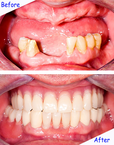 AG-DentalPlus-เปลี่ยนฟันพังให้สวยปัง-1